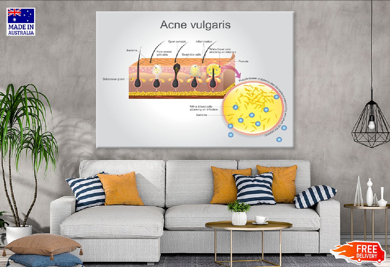 Acne Vulgaris Vector Illustration Print 100% Australian Made Stretched Canvas Ready to Hang - 2400