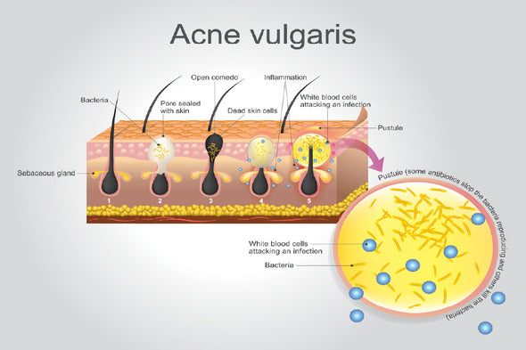 Acne Vulgaris Vector Illustration Print 100% Australian Made Stretched Canvas Ready to Hang - 2400