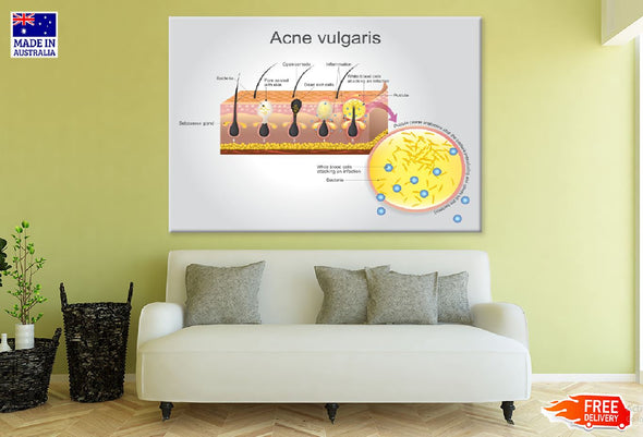 Acne Vulgaris Vector Illustration Print 100% Australian Made Stretched Canvas Ready to Hang - 2400