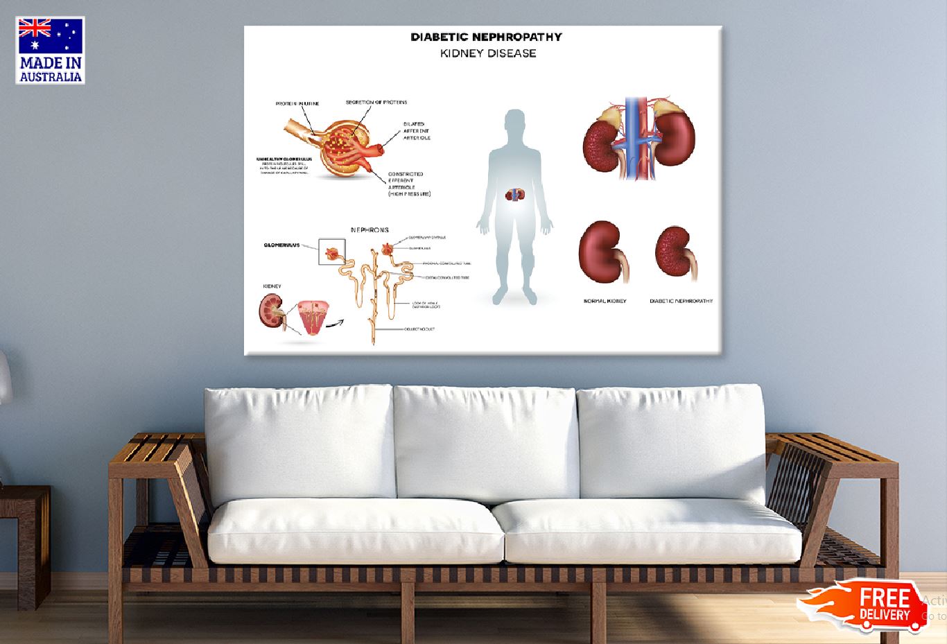 Diabetic Nephropathy Vector Design Print 100% Australian Made Stretched Canvas Ready to Hang - 2403