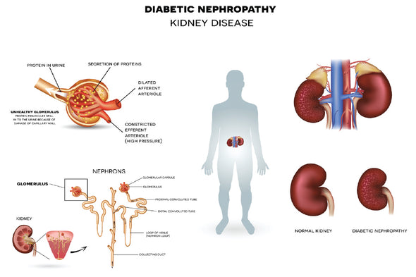 Diabetic Nephropathy Vector Design Print 100% Australian Made Stretched Canvas Ready to Hang - 2403