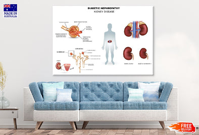 Diabetic Nephropathy Vector Design Print 100% Australian Made Stretched Canvas Ready to Hang - 2403