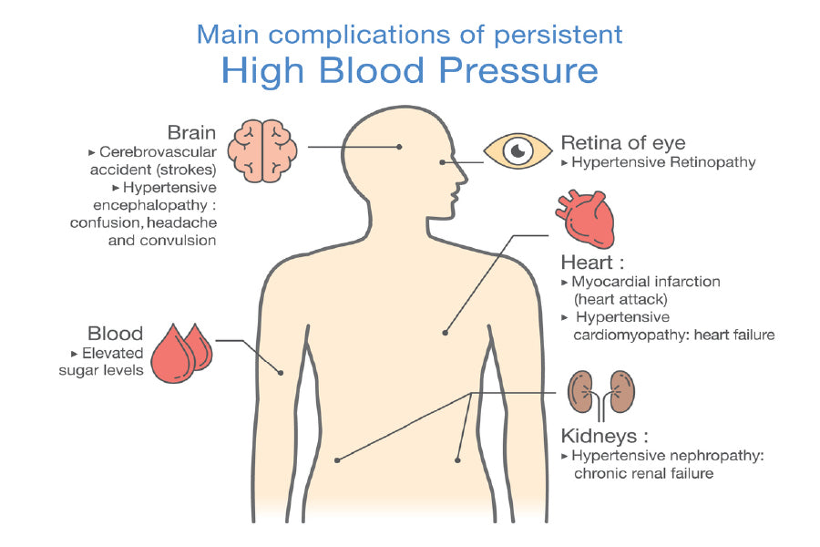 Human High Blood Pressure Anatomy Print 100% Australian Made Stretched Canvas Ready to Hang - 2406