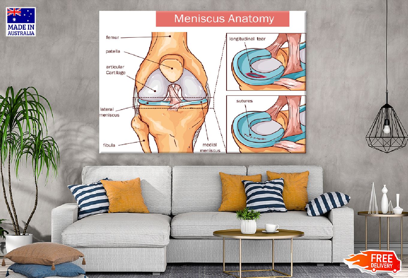 Meniscus Anatomy Vector Illustration Print 100% Australian Made Stretched Canvas Ready to Hang - 2407