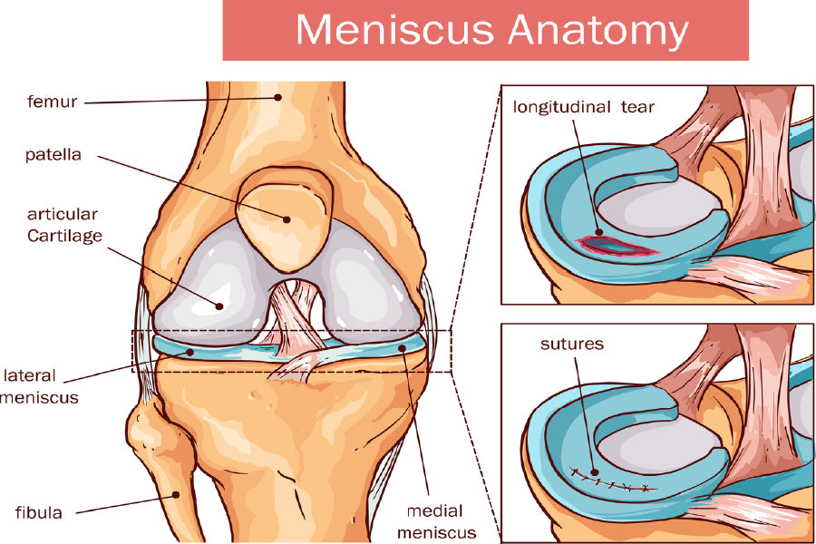 Meniscus Anatomy Vector Illustration Print 100% Australian Made Stretched Canvas Ready to Hang - 2407