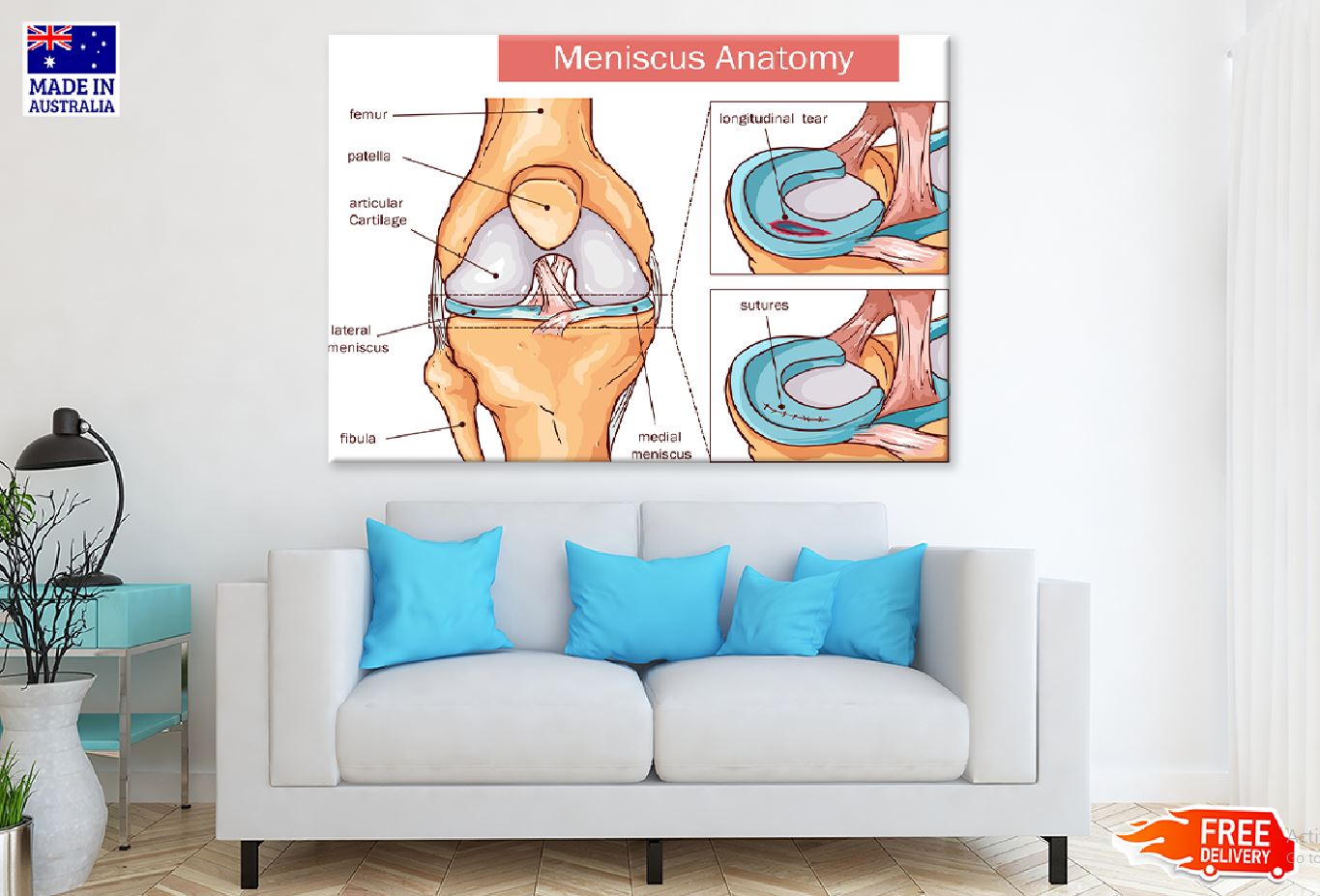 Meniscus Anatomy Vector Illustration Print 100% Australian Made Stretched Canvas Ready to Hang - 2407