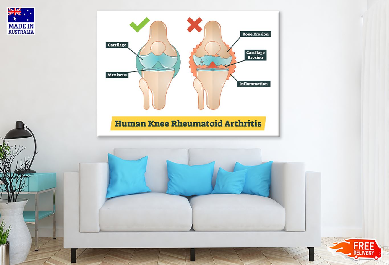 Human Knee Rheumatoid Arthritis Vector Print 100% Australian Made Stretched Canvas Ready to Hang - 2409