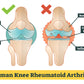 Human Knee Rheumatoid Arthritis Vector Print 100% Australian Made Stretched Canvas Ready to Hang - 2409
