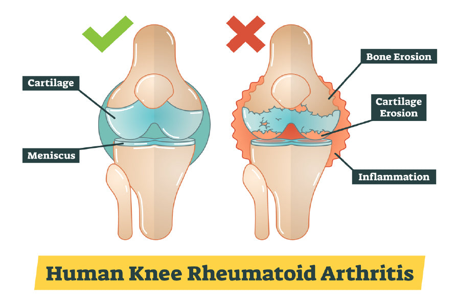 Human Knee Rheumatoid Arthritis Vector Print 100% Australian Made Stretched Canvas Ready to Hang - 2409