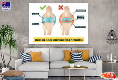 Human Knee Rheumatoid Arthritis Vector Print 100% Australian Made Stretched Canvas Ready to Hang - 2409