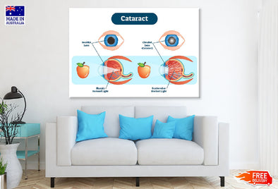 Human Eye Cataract Anatomy Vector Print 100% Australian Made Stretched Canvas Ready to Hang - 2411