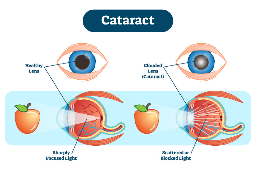 Human Eye Cataract Anatomy Vector Print 100% Australian Made Stretched Canvas Ready to Hang - 2411