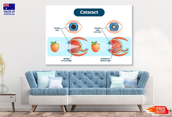 Human Eye Cataract Anatomy Vector Print 100% Australian Made Stretched Canvas Ready to Hang - 2411