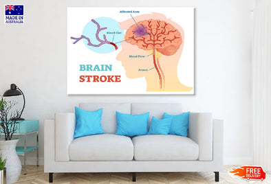 Brain Stroke Vector Anatomy Print 100% Australian Made Stretched Canvas Ready to Hang - 2413