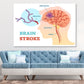 Brain Stroke Vector Anatomy Print 100% Australian Made Stretched Canvas Ready to Hang - 2413