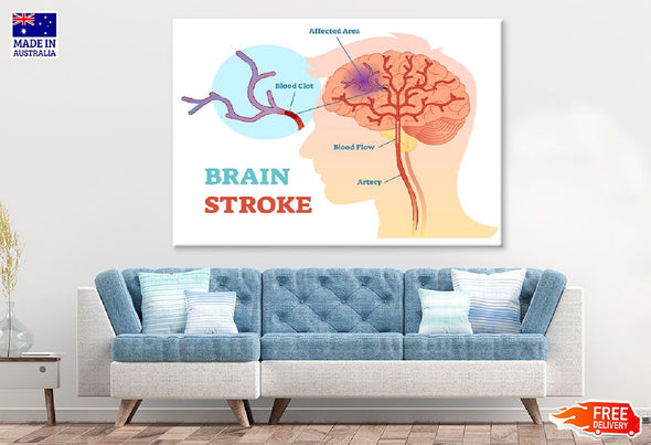 Brain Stroke Vector Anatomy Print 100% Australian Made Stretched Canvas Ready to Hang - 2413