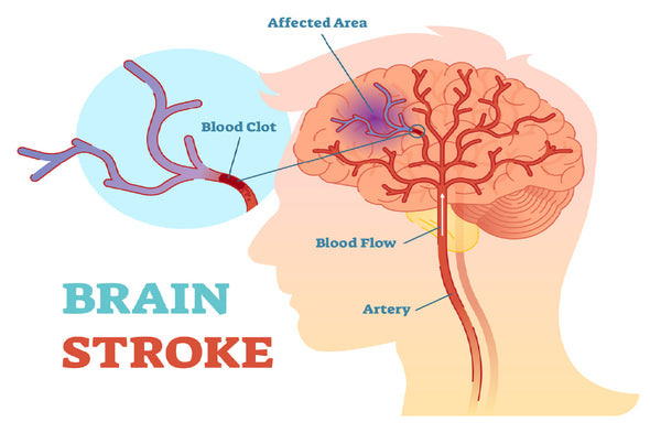 Brain Stroke Vector Anatomy Print 100% Australian Made Stretched Canvas Ready to Hang - 2413