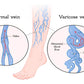 Human Normal & Varicose Vein Vector Print 100% Australian Made Stretched Canvas Ready to Hang - 2416