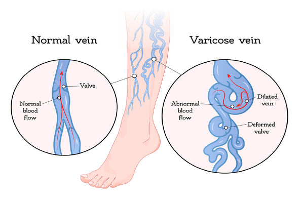 Human Normal & Varicose Vein Vector Print 100% Australian Made Stretched Canvas Ready to Hang - 2416