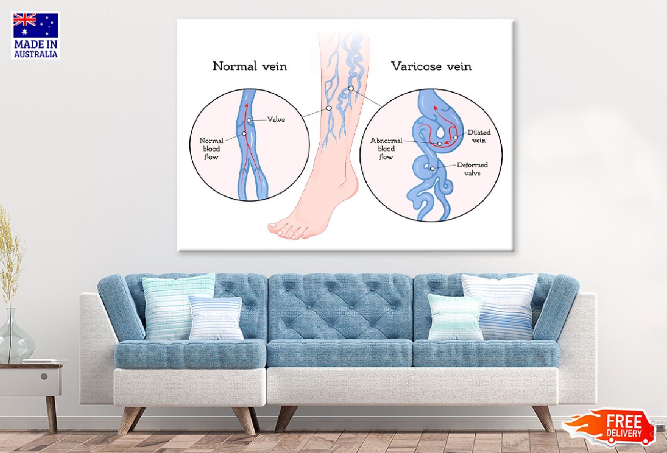 Human Normal & Varicose Vein Vector Print 100% Australian Made Stretched Canvas Ready to Hang - 2416