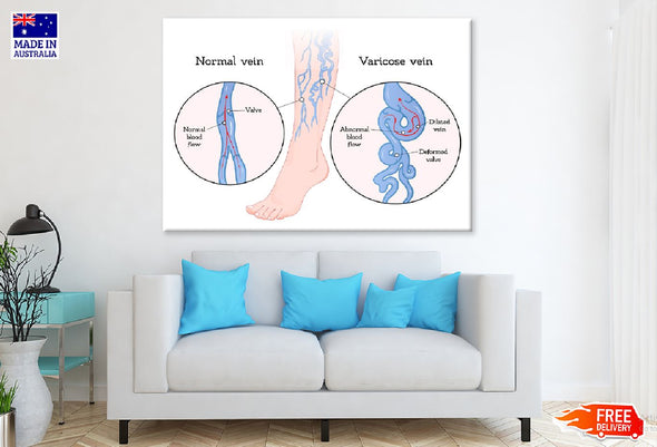 Human Normal & Varicose Vein Vector Print 100% Australian Made Stretched Canvas Ready to Hang - 2416