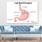 Lap Band Surgery Vector Anatomy Print 100% Australian Made Stretched Canvas Ready to Hang - 2421