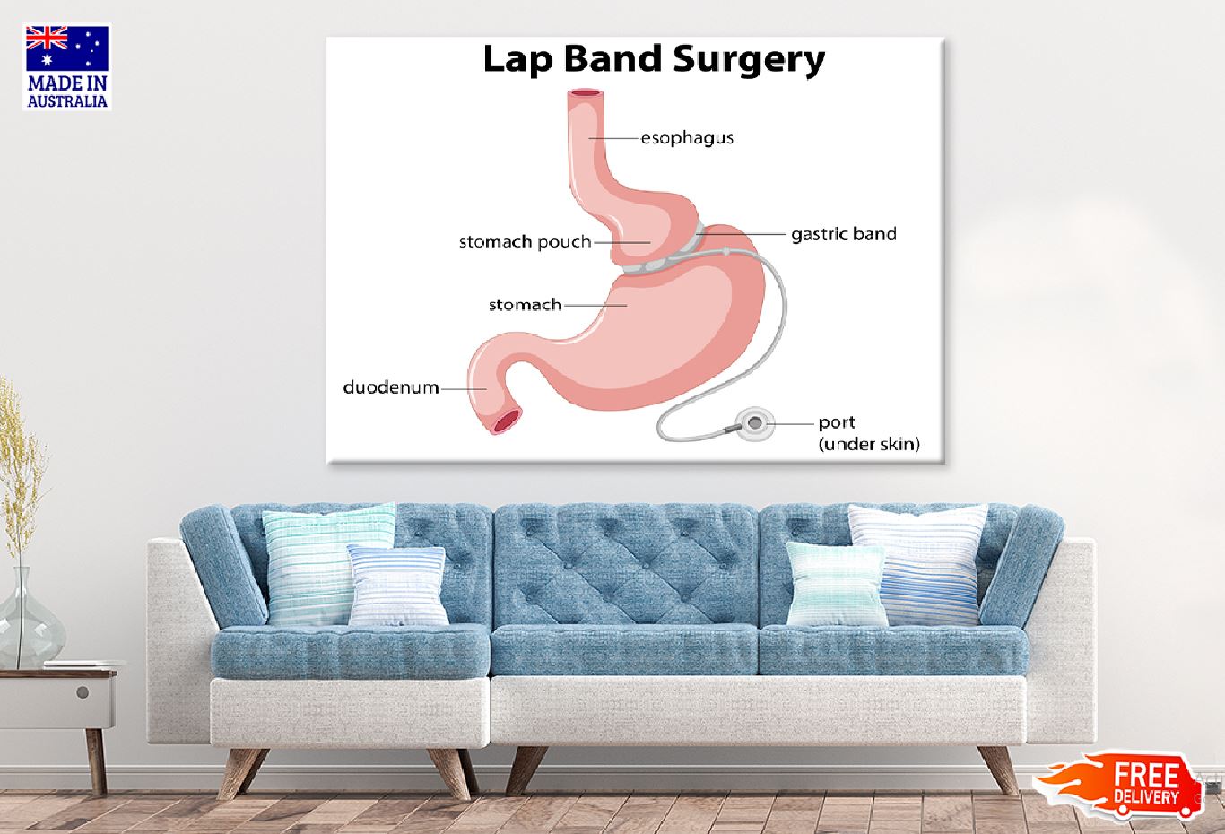 Lap Band Surgery Vector Anatomy Print 100% Australian Made Stretched Canvas Ready to Hang - 2421