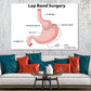 Lap Band Surgery Vector Anatomy Print 100% Australian Made Stretched Canvas Ready to Hang - 2421