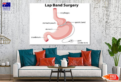 Lap Band Surgery Vector Anatomy Print 100% Australian Made Stretched Canvas Ready to Hang - 2421