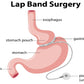 Lap Band Surgery Vector Anatomy Print 100% Australian Made Stretched Canvas Ready to Hang - 2421