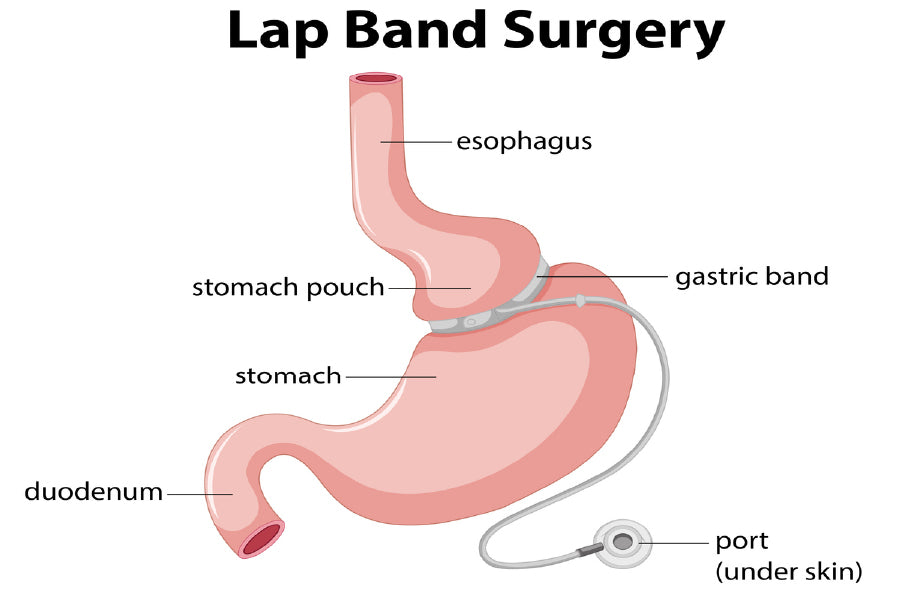 Lap Band Surgery Vector Anatomy Print 100% Australian Made Stretched Canvas Ready to Hang - 2421