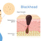 Human Blackhead Anatomy Vector Print 100% Australian Made Stretched Canvas Ready to Hang - 2423