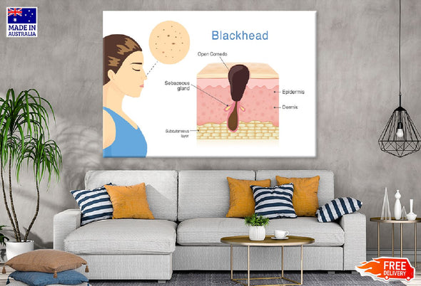 Human Blackhead Anatomy Vector Print 100% Australian Made Stretched Canvas Ready to Hang - 2423