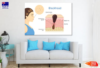 Human Blackhead Anatomy Vector Print 100% Australian Made Stretched Canvas Ready to Hang - 2423