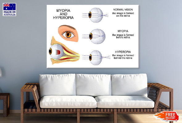 Human Myopia & Hyperopia Eye Anatomy Print 100% Australian Made Stretched Canvas Ready to Hang - 2426