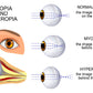 Human Myopia & Hyperopia Eye Anatomy Print 100% Australian Made Stretched Canvas Ready to Hang - 2426
