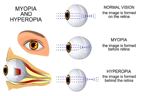 Human Myopia & Hyperopia Eye Anatomy Print 100% Australian Made Stretched Canvas Ready to Hang - 2426