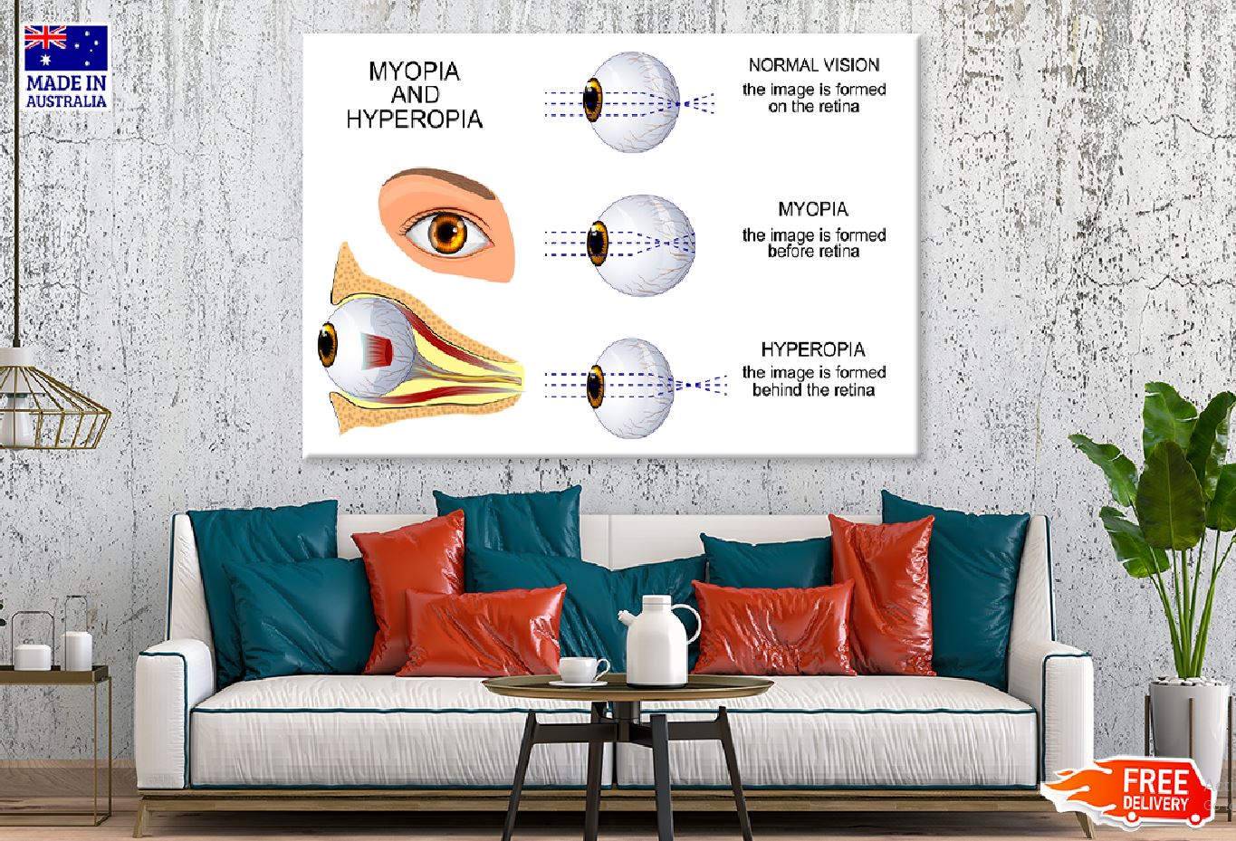 Human Myopia & Hyperopia Eye Anatomy Print 100% Australian Made Stretched Canvas Ready to Hang - 2426