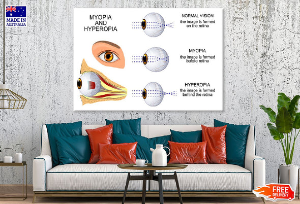 Human Myopia & Hyperopia Eye Anatomy Print 100% Australian Made Stretched Canvas Ready to Hang - 2426