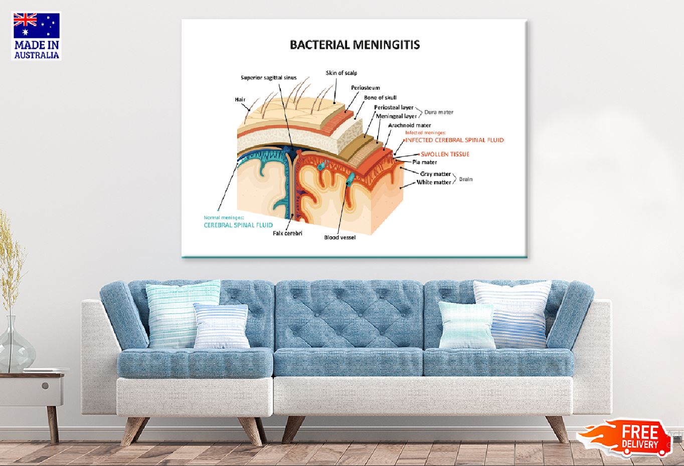 Bacterial Meningitis Vector Design Print 100% Australian Made Stretched Canvas Ready to Hang - 2429