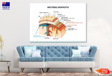 Bacterial Meningitis Vector Design Print 100% Australian Made Stretched Canvas Ready to Hang - 2429