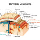 Bacterial Meningitis Vector Design Print 100% Australian Made Stretched Canvas Ready to Hang - 2429