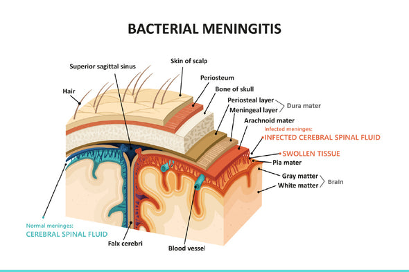 Bacterial Meningitis Vector Design Print 100% Australian Made Stretched Canvas Ready to Hang - 2429