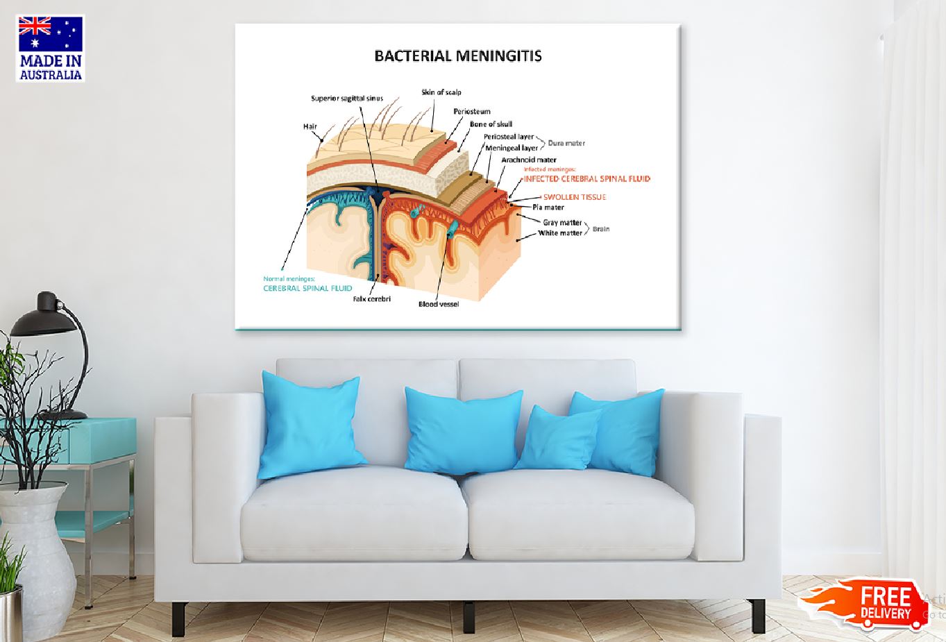 Bacterial Meningitis Vector Design Print 100% Australian Made Stretched Canvas Ready to Hang - 2429