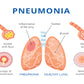 Pneumonia & Healthy Lung Anatomy Print 100% Australian Made Stretched Canvas Ready to Hang - 2435