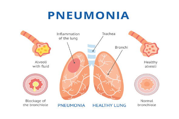 Pneumonia & Healthy Lung Anatomy Print 100% Australian Made Stretched Canvas Ready to Hang - 2435