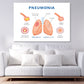 Pneumonia & Healthy Lung Anatomy Print 100% Australian Made Stretched Canvas Ready to Hang - 2435