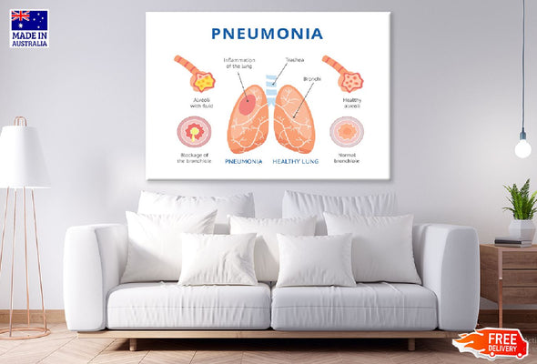 Pneumonia & Healthy Lung Anatomy Print 100% Australian Made Stretched Canvas Ready to Hang - 2435