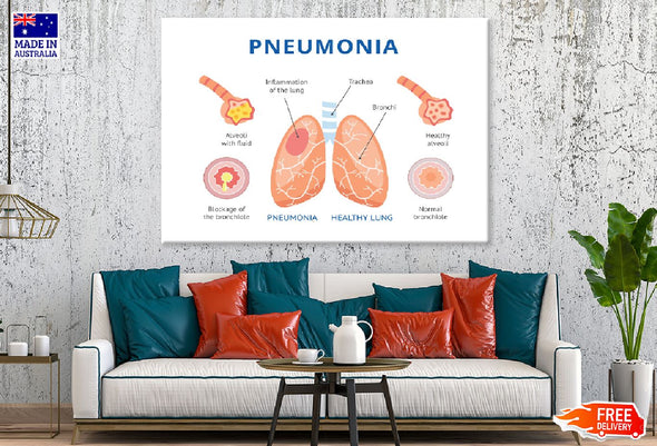 Pneumonia & Healthy Lung Anatomy Print 100% Australian Made Stretched Canvas Ready to Hang - 2435