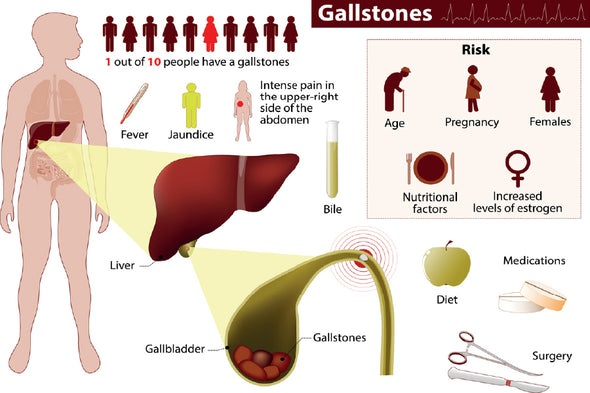 Human Gallstones Vector Illustration Print 100% Australian Made Stretched Canvas Ready to Hang - 2391